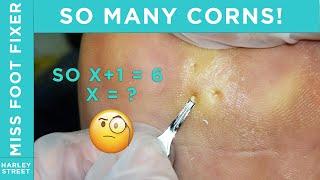 Satisfying multiple corns removal  | corn removal |  By Miss Foot Fixer Marion Yau