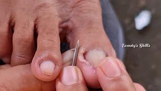 Thick callus on big toe/ingrown removal(Part1) | Beauty's Skills