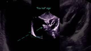 fox tail sign