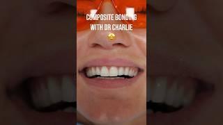 Invisalign 🫱‍🫲 Composite Bonding #dentist #teeth #invisalign #compositebonding #veneers