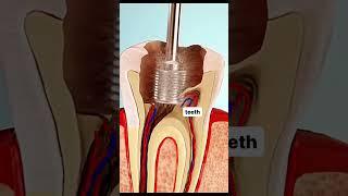 Root canal procedure|RCT technique lets watch the video|Endodontic Dentistry