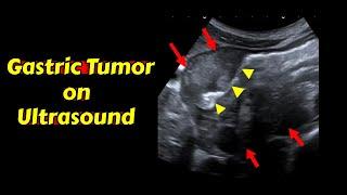 Gastric tumor | Ultrasound Case