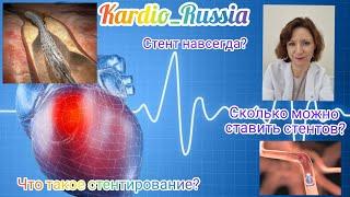 🫀Стентирование - что это такое? Стент ставится навсегда? Сколько можно поставить стентов? #кардиолог