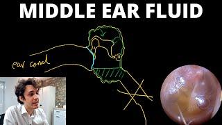 Why Does Fluid Build Up Behind The Eardrum? (Otitis Media With Effusion)