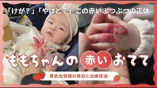 赤ちゃんの赤い模様苺みたいな手の秘密と成長記録  〜私たちの思い〜