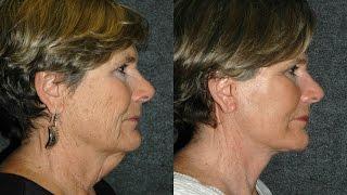 Face Lift Before and After NYC 60 year old woman | Dr Andrew Jacono Facelift #mini-facelift