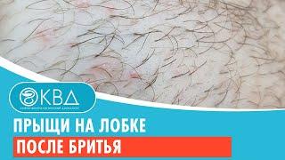  Прыщи на лобке после бритья. Клинический случай №930