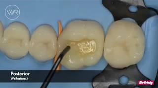 2 - How to use the 3ssential kit by WeRestore for an Additive procedure