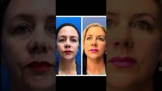 Reno/Tahoe Morpheus+CO2 Laser Healing from Skin Tightening and Resurfacing | Dr. Erez Dayan