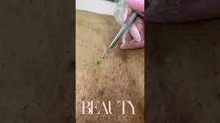 Ingrown Hair Removal