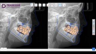 Progressive Medit Ortho Simulation App Demonstration | Feat. Dr. Collins Harrell