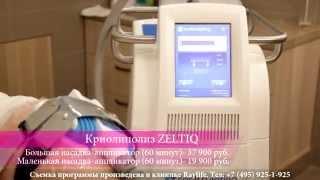 Криолиполиз Zeltiq