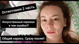 Остеотомия (искусственный перелом) для удлинения ноги. Аппарат Илизарова