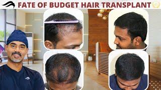 Hair Transplant In Bangalore | Best Clinic Doctor & Results Of Hair Transplant In Bangalore