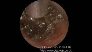 1,623 - Removing Ear Wax from my UNCLE’S Ear after he used Q-TIPS!