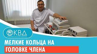  Мелкие кольца на головке члена. Клинический случай №650