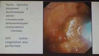 18 Мелкомуков ВА Эндоскопическая реканализация опухолевого стеноза трахеоброхиального дерева