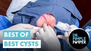 Dr Pimple Popper’s BEST OF THE BEST CYSTS!