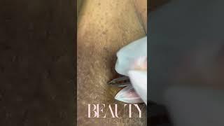 Ingrown Hair Removals