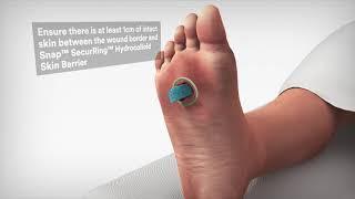 3M™ Snap™ Therapy System Application & Mechanism of Action (MOA)