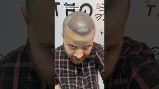 Amazing Hair Transplant Surgery | Latest Fue Technique #shorts #viral #hair transplant