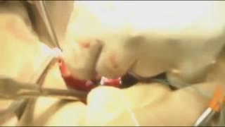 Pulmonary Valve replacement with Tissue valve at Bangabandhu Sheikh Mujib Medical University( BSMMU)