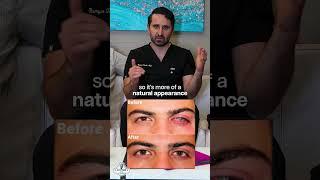 Enucleation vs. Evisceration: Eye Removal Procedures Explained