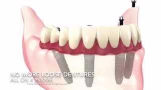 All on 4 Implants | Nuffield Dental Clinics Singapore