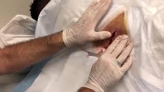 Infected Skin Cyst by Dr  John Gilmore