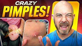 Blackhead Extractions, Pimple Pops, and MORE! Dermatologist Reacts