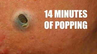 157 Cysts, Abscesses and Pimples!  Comedones and Whiteheads