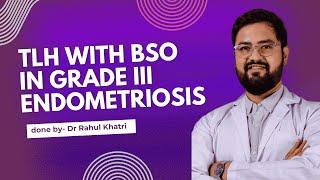 Total Laparoscopic Hysterectomy with BSO in Grade III Endometriosis, done by Dr. Rahul Khatri