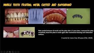 Technical Education The Series ( Part 6  - superbond for mobile teeth fixation)