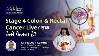 Stage 4 Colon & Rectal Cancer Liver तक कैसे फैलता है? | Stage 4 Cancer Explained | SSO Hospital