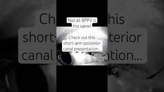 Short-arm posterior canal BPPV #vertigo #bppv #vestibular #dizziness