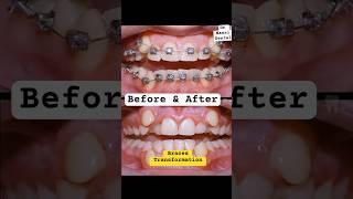 BRACES TRANSFORMATION, before and After