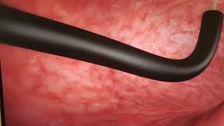 ESG- Endoscopic Sleeve Gastroplasty