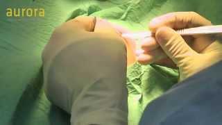 Bilateral Inverted Nipple Correction Surgery at Aurora Clinics