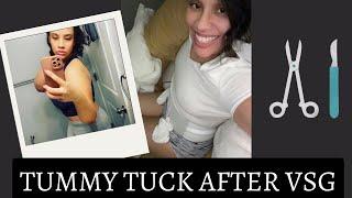 Tummy Tuck After VSG.. #abdominalplasty #NEVER HAVING SURGERY AGAIN!!!