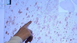 Artificial Intelligence Tool Developed for Alzheimer’s Research