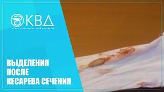  1473  Выделения после кесарева сечения