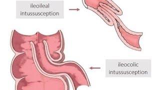 Case of intussusception| Severe abdominal pain since 2 days| Procare diagnostic centre.