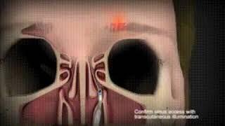 Gaymarit - Sinusdan yiringni olib tashlash. | Haymaritis is the removal of pus from the sinus.