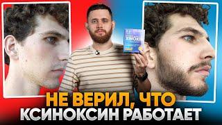 На щеках совсем не росла борода, но всего за 100 дней ксиноксин помог