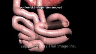 Intussusception Treatment video - Animaton by Cal Shipley, M.D.