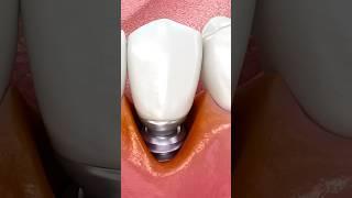 How Tooth Implants are Able to Fuse With Bone