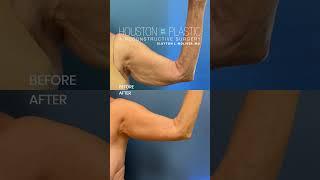 Arm lift before and after. #armlifting #plasticsurgeons #shorts