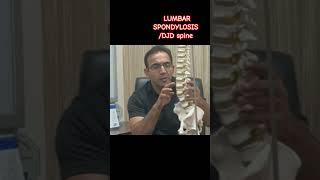 what is the Main cause of Low Back Pain | LUMBAR SPONDYLOSIS |watch full video below