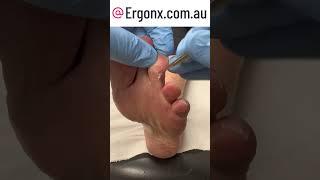 Callus removal from toe in podiatry clinic