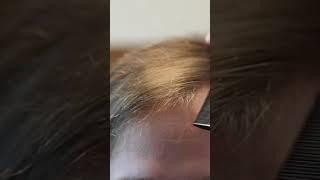 The Journey of a Hair Transplant | Elithair #shorts